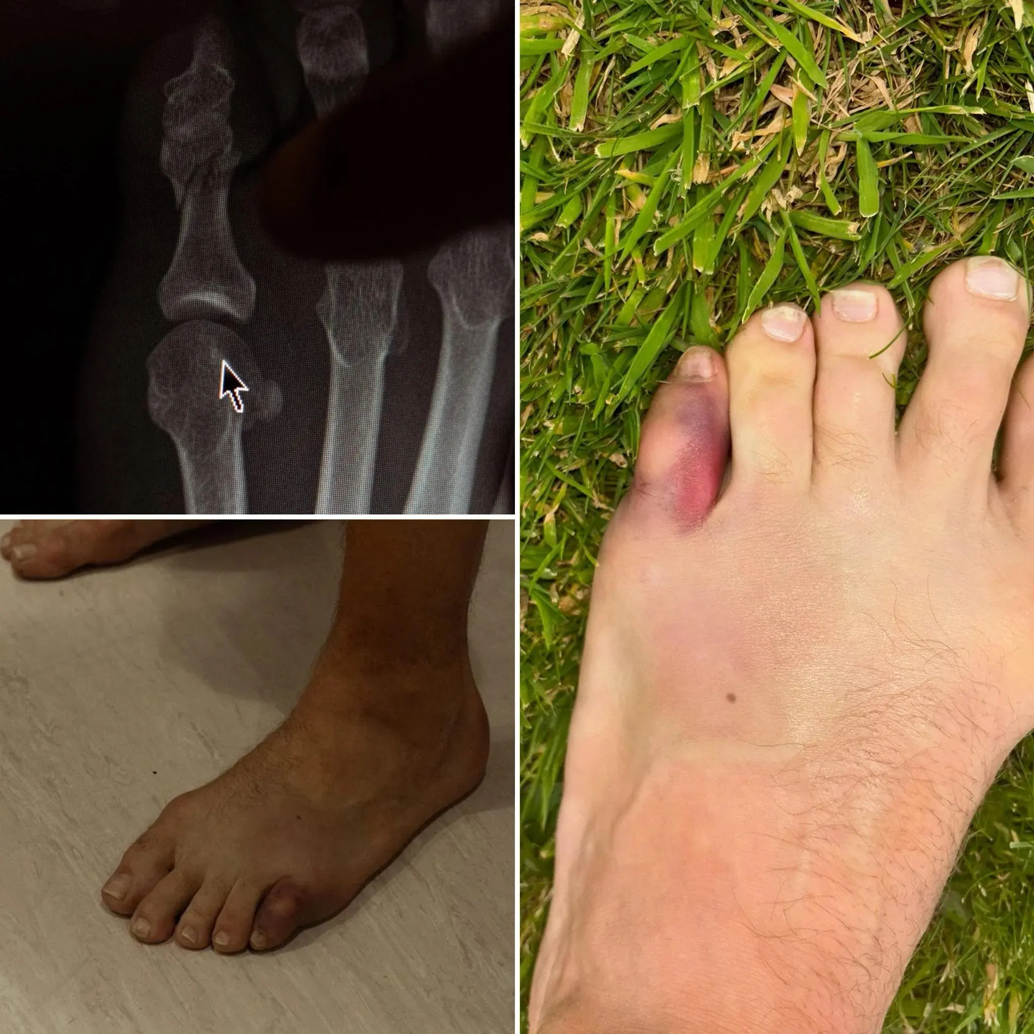 Conor McGregor's broken toe injury ahead of UFC 303